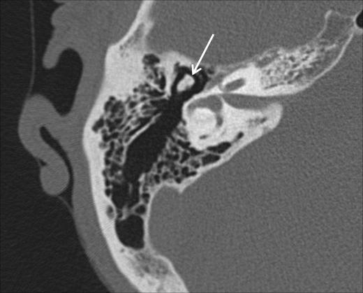 A B Figura 11 Visualização de cabeça do martelo (setas). Em A, plano coronal orelha direita. Em B, mesma orelha em plano axial.