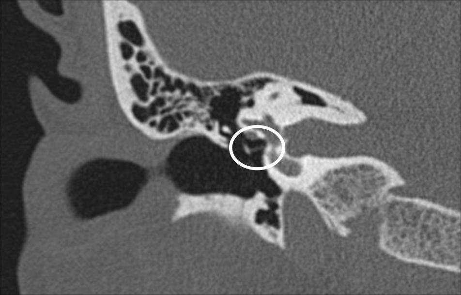 Figura 16 Plano coronal orelha direita. Articulação incudoestapediana com visualização da janela oval (elipse) no mesotímpano. A mastóide foi minuciosamente avaliada.