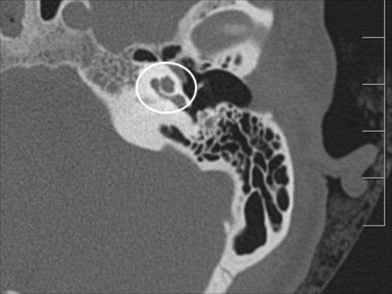 CÓCLEA Foram descritas as espiras cocleares, se desenvolvidas e se acometidas por doença inflamatória, representada por erosões, fístulas ou calcificações.