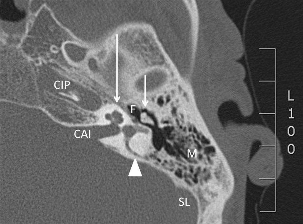 Figura 26 Estruturas vistas em um corte do plano axial orelha esquerda: artéria carótida intrapetrosa (CIP), conduto auditivo interno (CAI), espiras cocleares (seta longa), nervo facial (F),