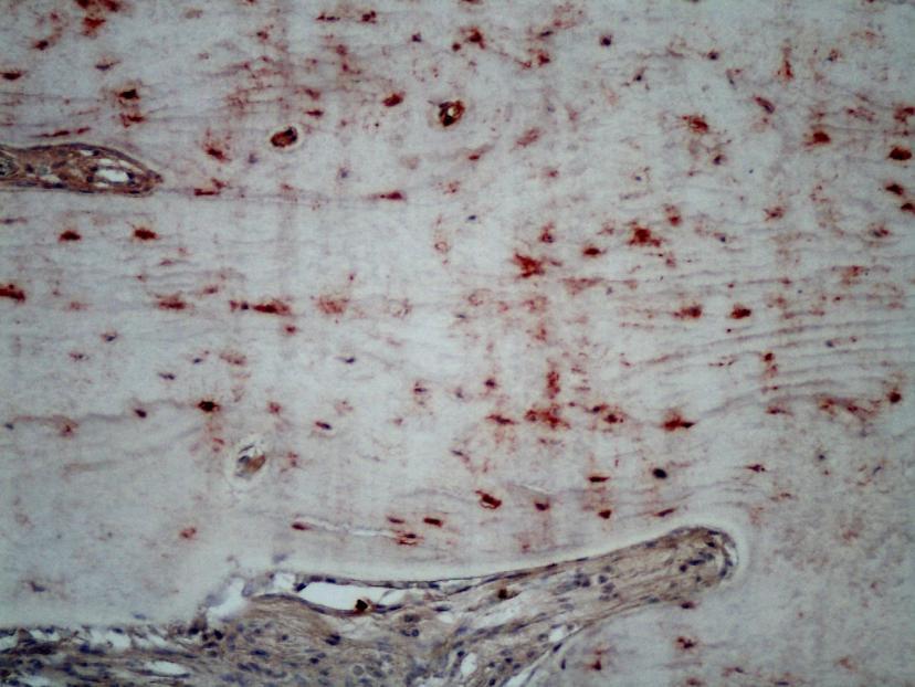 Aumento 400x. Figura 6. Expressão proteína MEPE em tecido cortical de paciente com fratura.