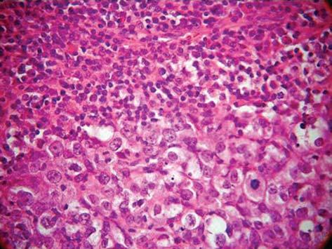 Carcinoma medular da mama: correlação anátomo-radiológica Figura 1. Lesão bem delimitada constituída por células tumorais dispostas em lençol separadas por pequena quantidade de tecido conectivo.