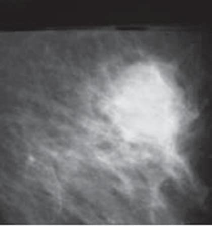 Matheus VS et al. A B C Figura 3. Mamografia mostra nódulo de forma irregular e margem obscurecida (A). Categoria IV BI-RADS. Apresenta-se hipoecóico na ultra-sonografia (B,C).