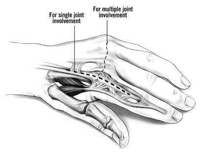 TÉCNICA CIRÚRGICA Implante Ortopédico Introdução Este manual descreve a seqüência de técnicas e instrumentos usados para implantar o (Figura 1A).