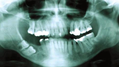 2009; 38(3) Cisto dentígero inflamatório relacionado a dente permanente: considerações etiopatológicas 145 Figura 1.