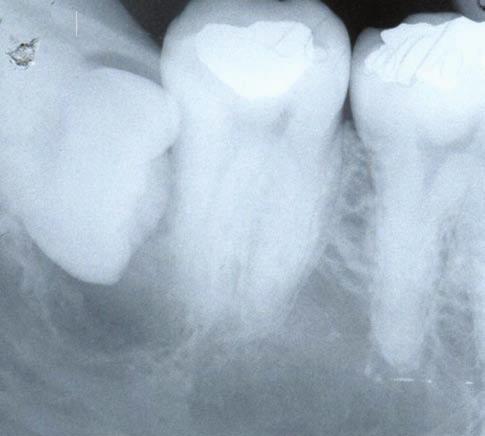 Imagem radiolúcida envolvendo a coroa do terceiro molar incluso e alterações radiográficas no primeiro e segundo molar, sugerindo processo infeccioso.