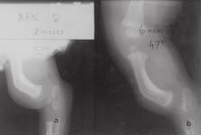 pacientes que apresentavam angulação tibial anterior foram divididos em dois grupos: Grupo 1 Casos nos quais ocorreu correção espontânea da deformidade, com o crescimento, para valores inferiores ou