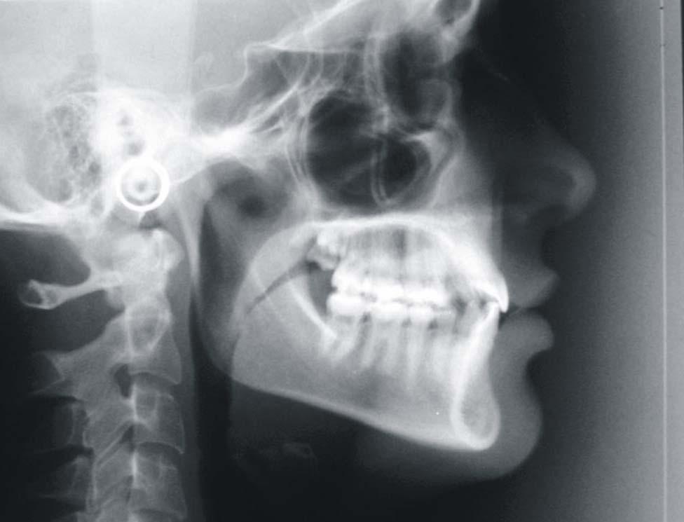 Material e Método 30 Os traçados cefalométricos das estruturas cranianas das telerradiografias em norma lateral direita foram realizados manualmente com auxílio de um negatoscópio de mesa de cristal