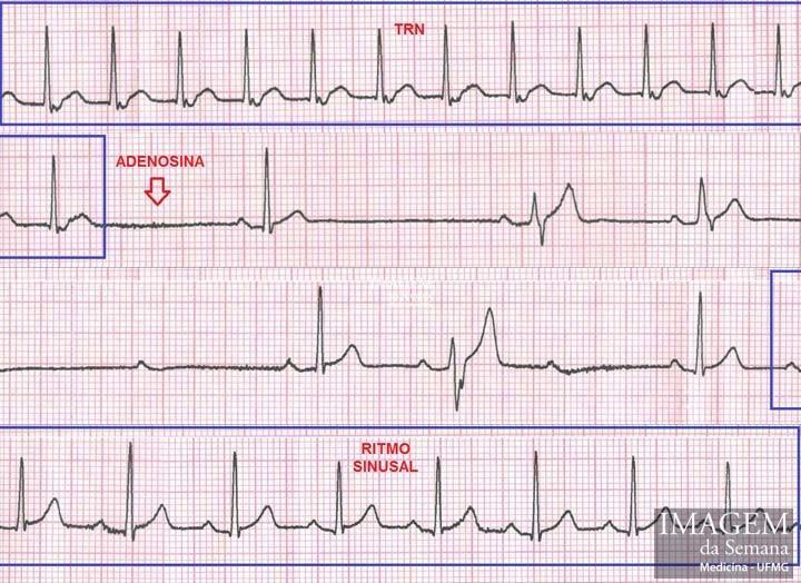 Figura 3: Derivação D3 do eletrocardiograma durante a administração de 6mg Adenosina EV - Adenosina