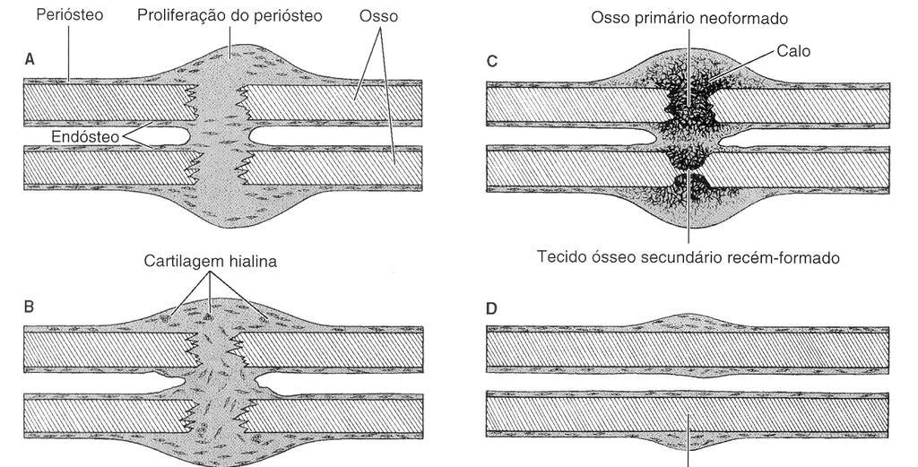 Questão 4 Processo de reparação da fratura, por formação de novo tecido ósseo a partir do endósteo e do periósteo. Luiz C. Junqueira, J. Carneiro. Histologia básica. 10. a ed.