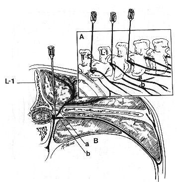 Anestesia paravertebral proximal Técnica de Farquharson,, Hall ou Cambridge Alternativa: Redireccionar a agulha cranialmente e avançar até atravessar o ligamento intertransverso.
