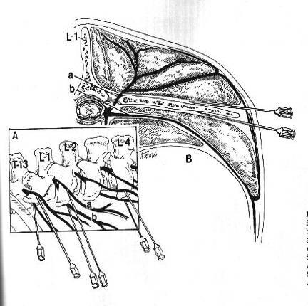 Anestesia paravertebral distal Técnica de Magda, Cakala ou Cornell Assépsia e insensibilização da pele sobre as extremidades das apófises transversas L1, L2, L3.