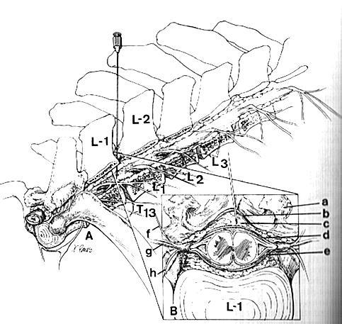 Anestesia paravertebral distal Técnica de Magda, Cakala ou Cornell Factores que reduzem a precisão do método: 1. Os nervos atravessam os espaços intertransversos obliquamente. 2.