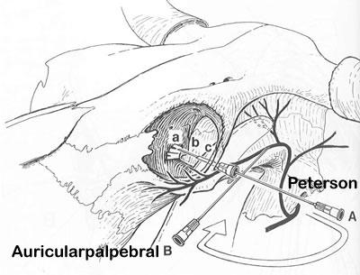 Técnicas de anestesia do globo ocular Técnica de Peterson: Agulha 14G x 2,5 cm (cânula) + 18Gx 12 cm.