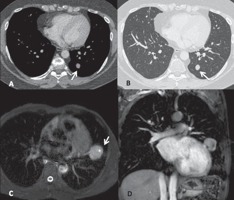 Na janela mediastinal identificase o nódulo endobrônquico bem delimitado, ovalado e com atenuação homogênea (seta em B). Figura 2. Carcinoides típicos.