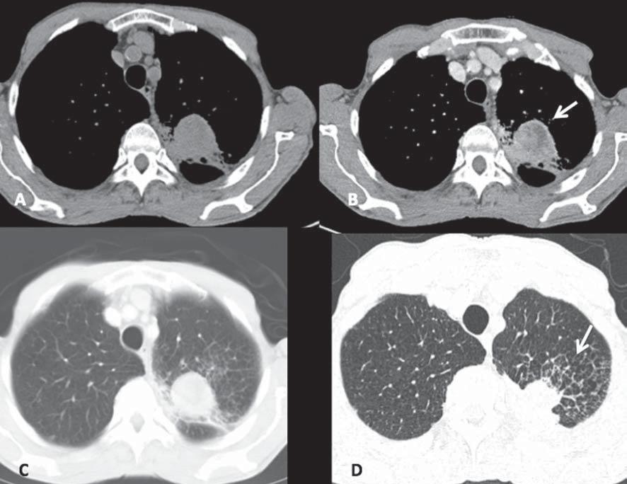 Figura 4. Carcinoide atípico. Imagens axiais de TC do tórax pré (A) e pós-contraste (B).