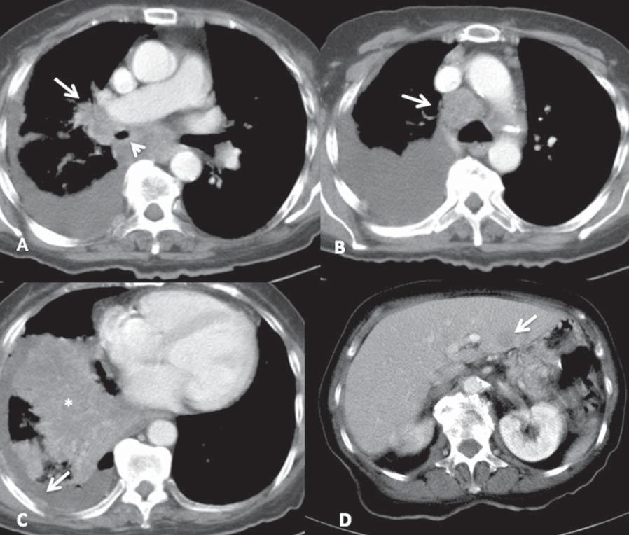 Figura 6. Câncer pulmonar de pequenas células. Lesão característica identificada em imagens de TC do tórax contrastada, janela mediastinal.