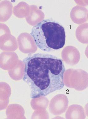 b Virocyte (1) with homogeneous deep blue stained cytoplasm in EBV