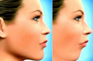 o Padrão II O Padrão II apresenta convexidade facial aumentada, em consequência do excesso maxilar, mais raro, ou pela deficiência mandibular.