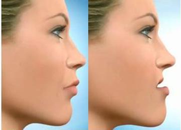 O Padrão Face Curta é identificado pela deficiência nas dimensões verticais, lábios comprimidos, maxila com expressão adequada e excesso da linha queixo-pescoço, devido à rotação anti-horária da