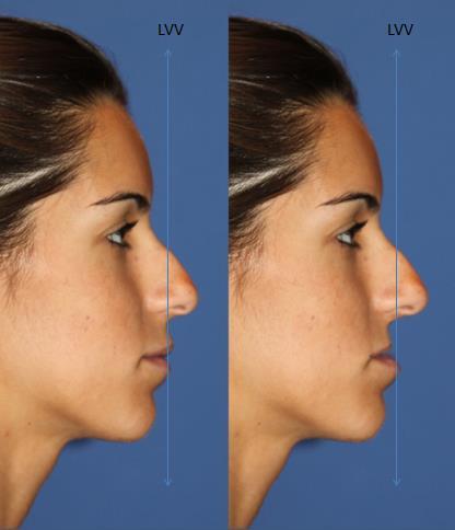 5- Principais pacientes com SAOS o Retrognatismo Maxilar: Portadores de deficiência horizontal da maxila, dentre as queixas mais comuns são: rosto afundado, ausência da maça do rosto, nariz muito