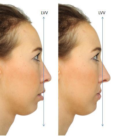 o Retrogantismo Mandibular: Portadores de deficiencia horizontal de mandibula, geralmente se queixam da projeção do mento (Figura 13). Figura 13: A. Perfil Facial Normal. B. Retrogantismo Mandibular. Dolphin Imaging 11.