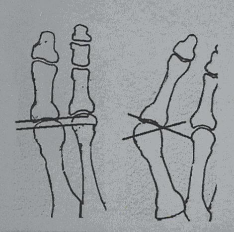 Avaliação comparativa das alterações estruturais do hálux valgo pela tomografia axial computadorizada e exame radiográfico Tabela 2 - Relação dos pés avaliados através de exame radiográfico e