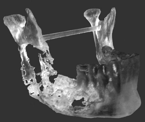 , individuo leucoderma, gênero masculino, com 21 anos de idade, apresenta lesão de aspecto multiloculado, acometendo