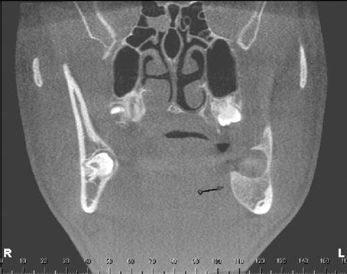 do ameloblastoma com as estruturas circunvizinhas como, por exemplo, o rompimento das corticais que só podem ser observadas com as reconstruções das tomografias computadorizadas 10.