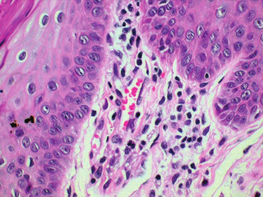 Figura 1. Exame histopatológico-língua: Granuloma macrofágico sub-epitelial (HE 400x) Figura 2.