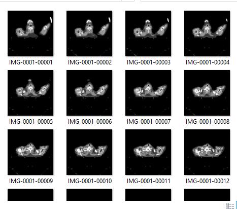 Neste projeto é apresentado o Fantoma 78, por ser obtido através de 78 imagens de fatias de CT de um paciente com carcinoma de mama, cujo arquivo foi encontrado disponível na internet. 2.