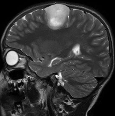 Lesões Corticais (Epileptogênicas)