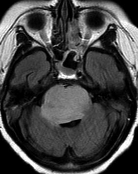 Astrocitoma Difuso de Baixo Grau OMS II Convulsões, HIC,