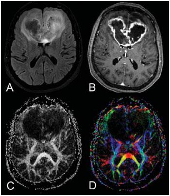 Glioblastoma Multiforme OMS grau IV De novo (90%) ou secundária (GBG ou AA) 5ª e 6ª décadas Classificação de acordo com o perfil