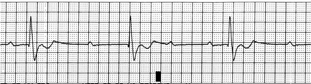 Bloqueio átrio-ventricular - de 2º Grau: é menos freqüente, estando geralmente associada a problemas graves como infarto ou isquemia miocárdica.