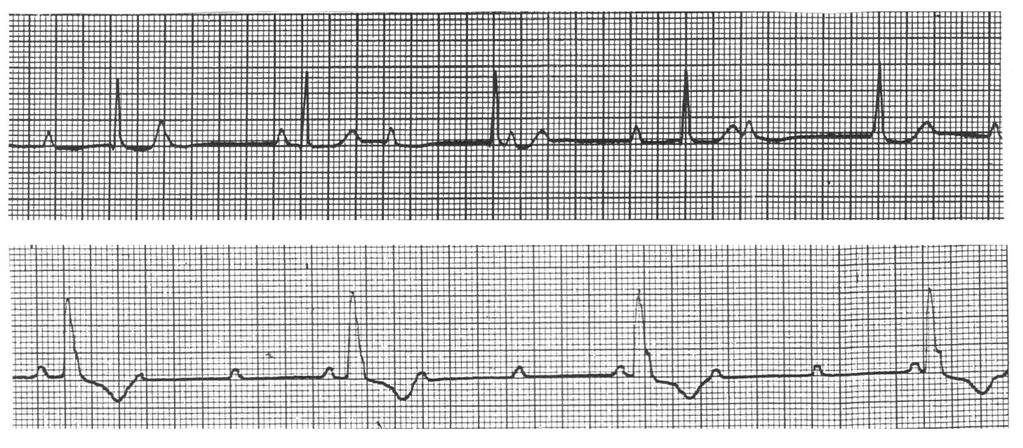 Bloqueio átrio-ventricular - de 3º Grau: é o mais sério tipo de bloqueio.