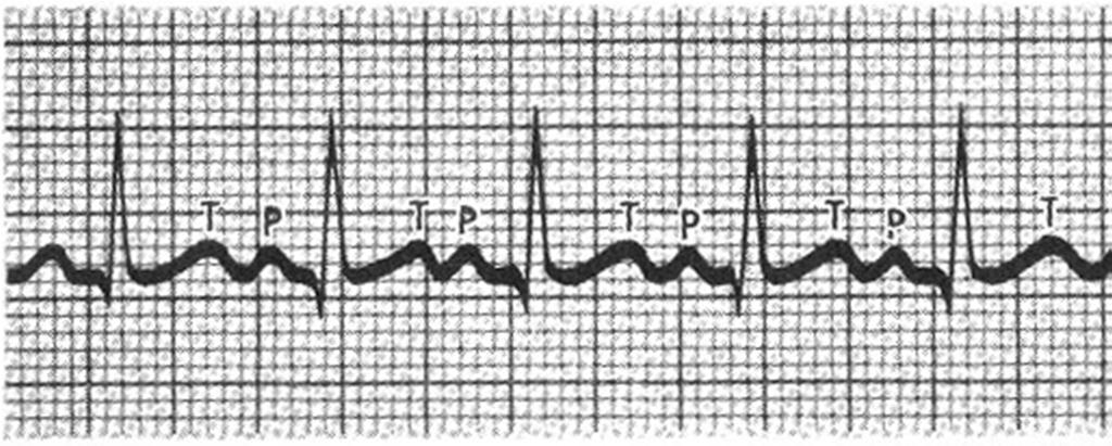 Taquicardia sinusal Taquicardia em geral com QRS estreito, precedidas por ondas P e FC acima de 100 BPM e em geral abaixo de 200 BPM em repouso.