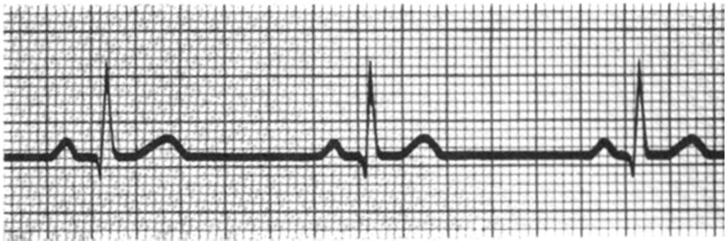 Bradicardia sinusal Presença de FC abaixo de 60 BPM, tendo complexos QRS precedidos de onda P, com PR normal.