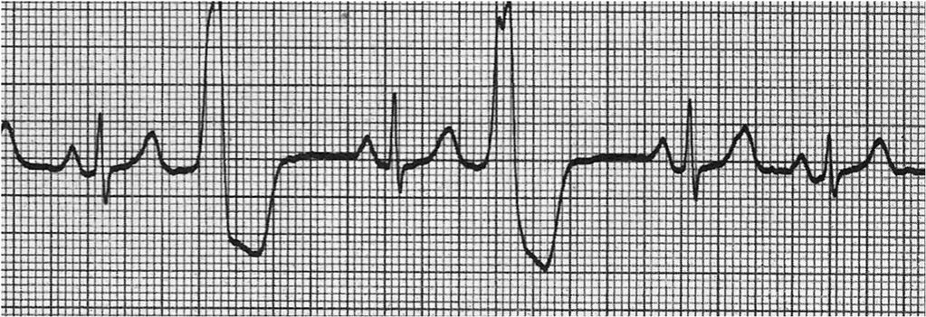 Extrassístoles Extrassístole Ventricular: É um batimento precoce que se origina nos ventrículos (1 QRS a mais).