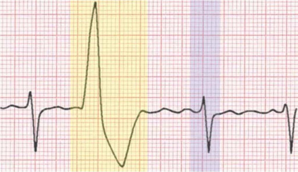 Extrassístoles Extrassístole Ventricular: É um batimento precoce que se origina nos ventrículos (1 QRS a mais).