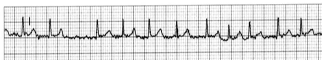 Fibrilação atrial Se caracteriza por não apresentar onda p, apenas um tremor na linha de base do ECG, e intervalos RR variáveis, aleatoriamente.