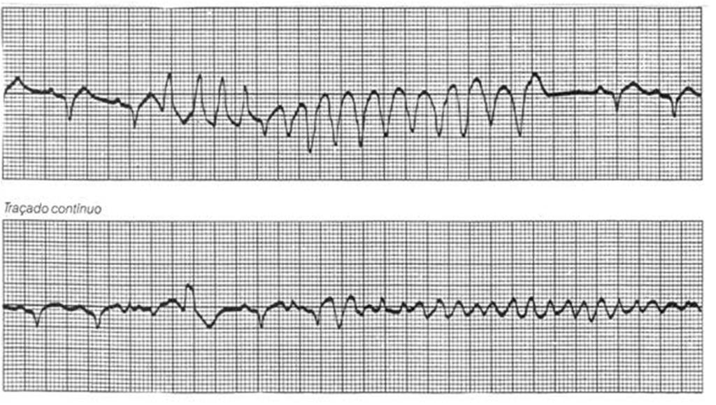 Fibrilação Ventricular Ritmo com ausência de onda P e de complexos QRS, apenas com ondulado irregular na linha de base com maior ou
