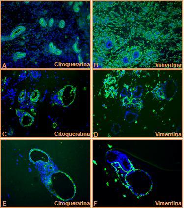 MARCAÇÃO IMUNOHISTOQUÍMICA DA CITOQUERATINA E DA VIMENTINA A e B - Tecido uterino (100x.) C, D, E e F - Células em cultura (200x).