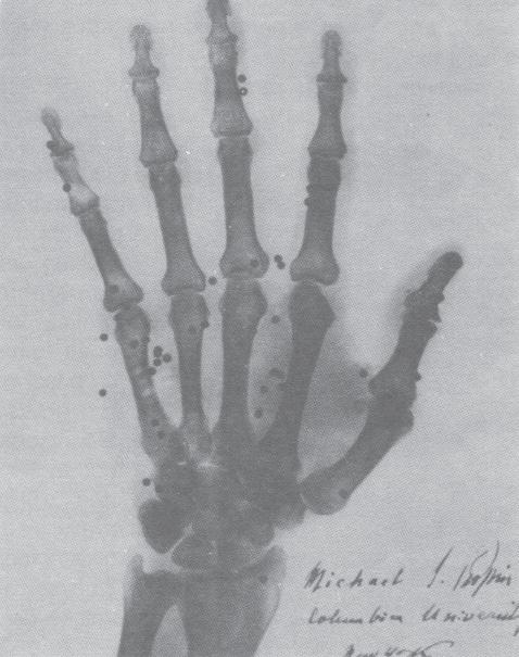 Primeira radiografia realizada no mundo, mostrando a mão da esposa de Röentgen.