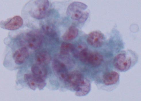 Resultado da punção aspirativa do nódulo pulmonar: Identificam-se alguns pequenos agregados de células epitelióides de citoplasma claro, núcleo arredondado com membrana bem definida,