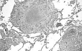Granuloma tuberculoso Na figura acima, visualizam-se granulomas tuberculosos do pulmão, centrados por necrose caseosa, reação linfocitária circunjacente acompanhada de