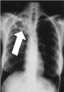 2.2.3 Exame Radiológico O exame radiológico é auxiliar no diagnóstico da tuberculose justificando-se sua utilização, se possível, nos casos suspeitos.
