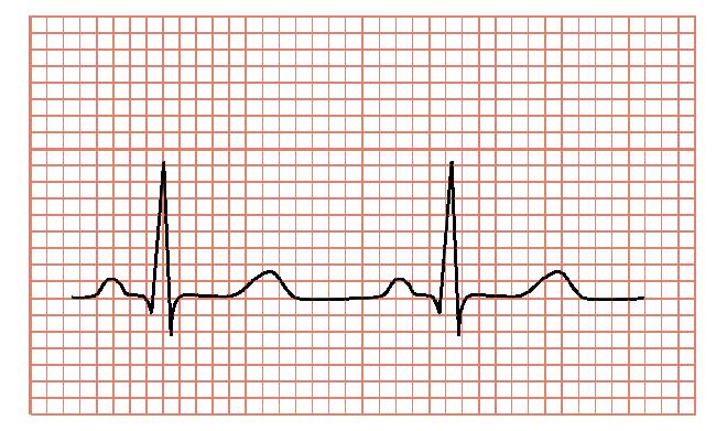 Eletrocardiograma Instrumento de avaliação da capacidade transmissão impulso cardíaco. O trabalho cardíaco produz sinais elétricos que passam para os tecidos vizinhos e chegam à pele.