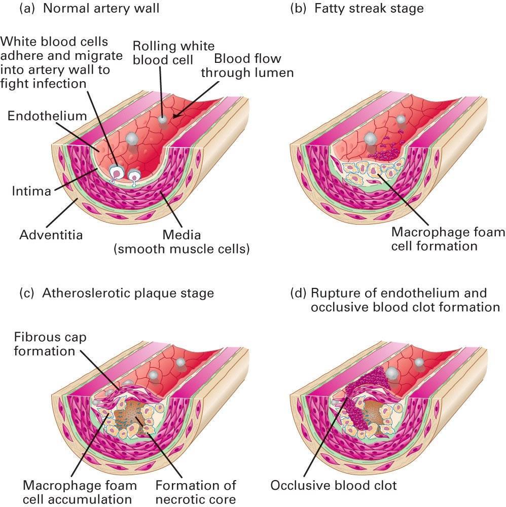15 a) Artéria com parede normal b) Fase estrias gordurosas Leucócitos aderem e migram para parede da artéria para combater a infecção Endotélio Leucócitos fluindo Fluxo de sangue através do lúmen