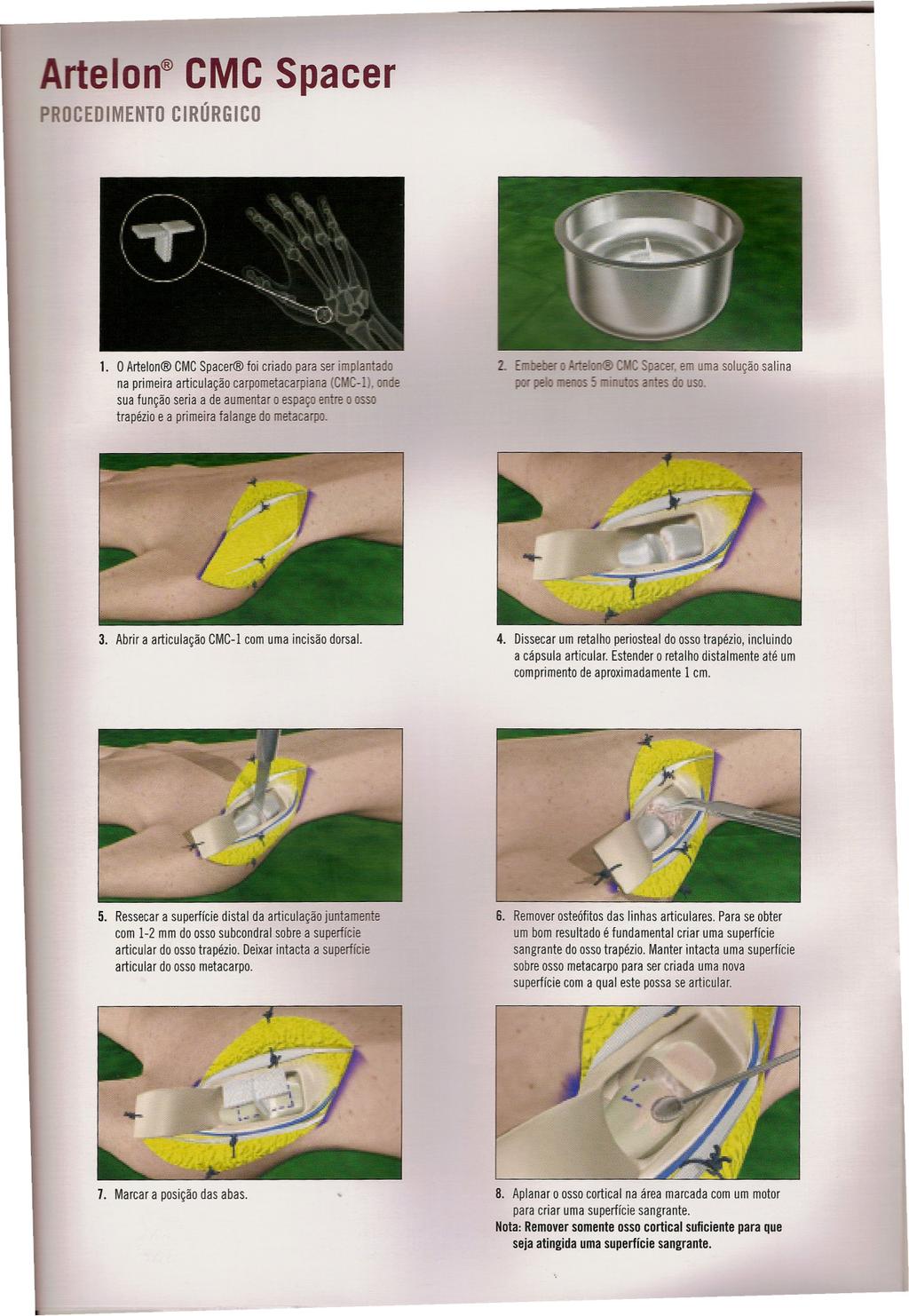 Artelon CMC Spacer PROCEDIMENTO CIRÚRGICO 1.